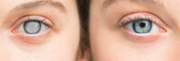 백내장 증상 좋은음식