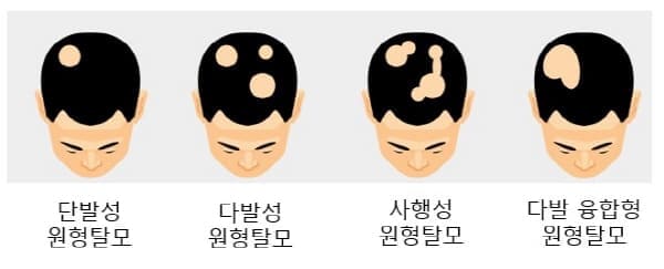 원형탈모의종류