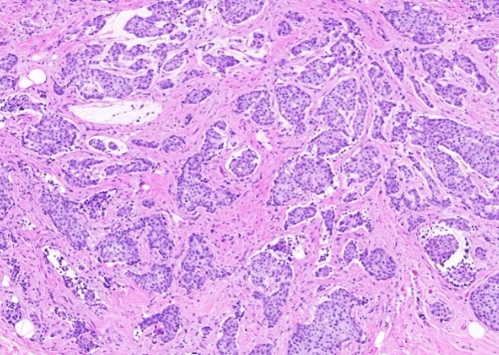 침윤성 유방암 퍼제타