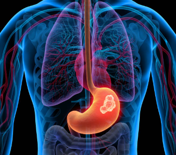 위암 초기증상, 수술비용, 수술후 회복기간 총정리 (2024ver)