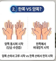 파킨슨병 초기증상