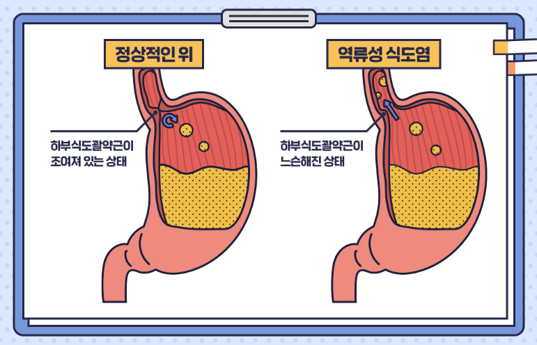 역류성 식도염
