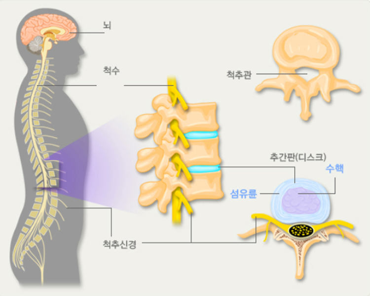 허리 삐끗했을때