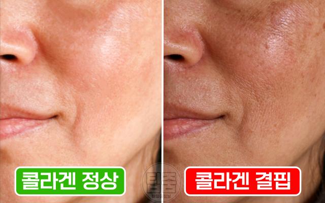 콜라겐 결핍증 부족증상 건조 칙칙한 피부