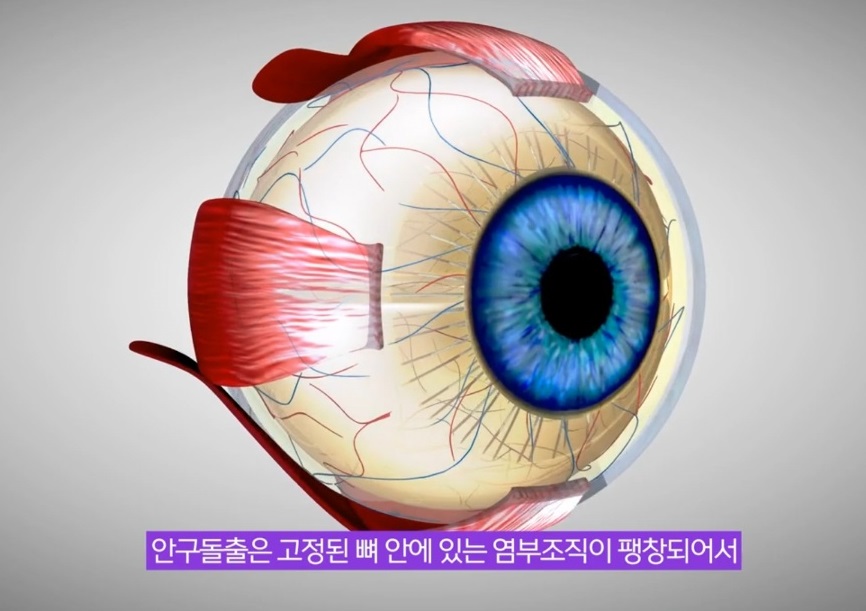 EBS명의-안검하수-윤진숙-교수