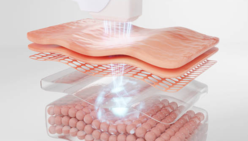 레이저 시술 원리