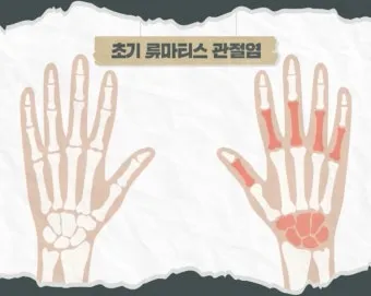 효과적인 류마티스 관절염 치료제 추천 약물 비교 가이드 2025 최신판_18