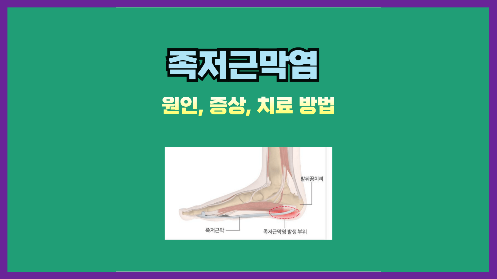 족저근막염의 원인, 증상, 치료 방법