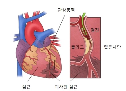 심근경색
