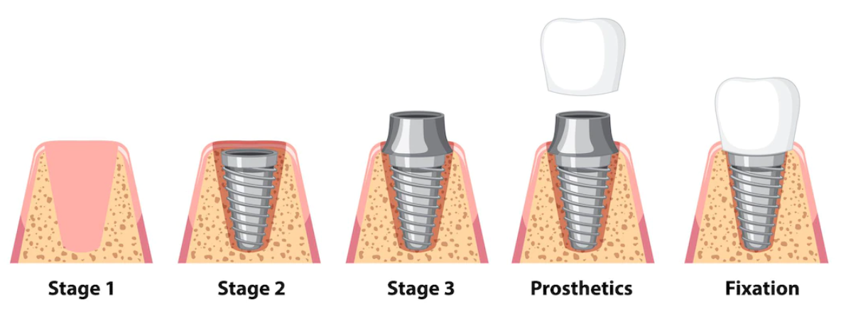 임플란트 시술의 단계