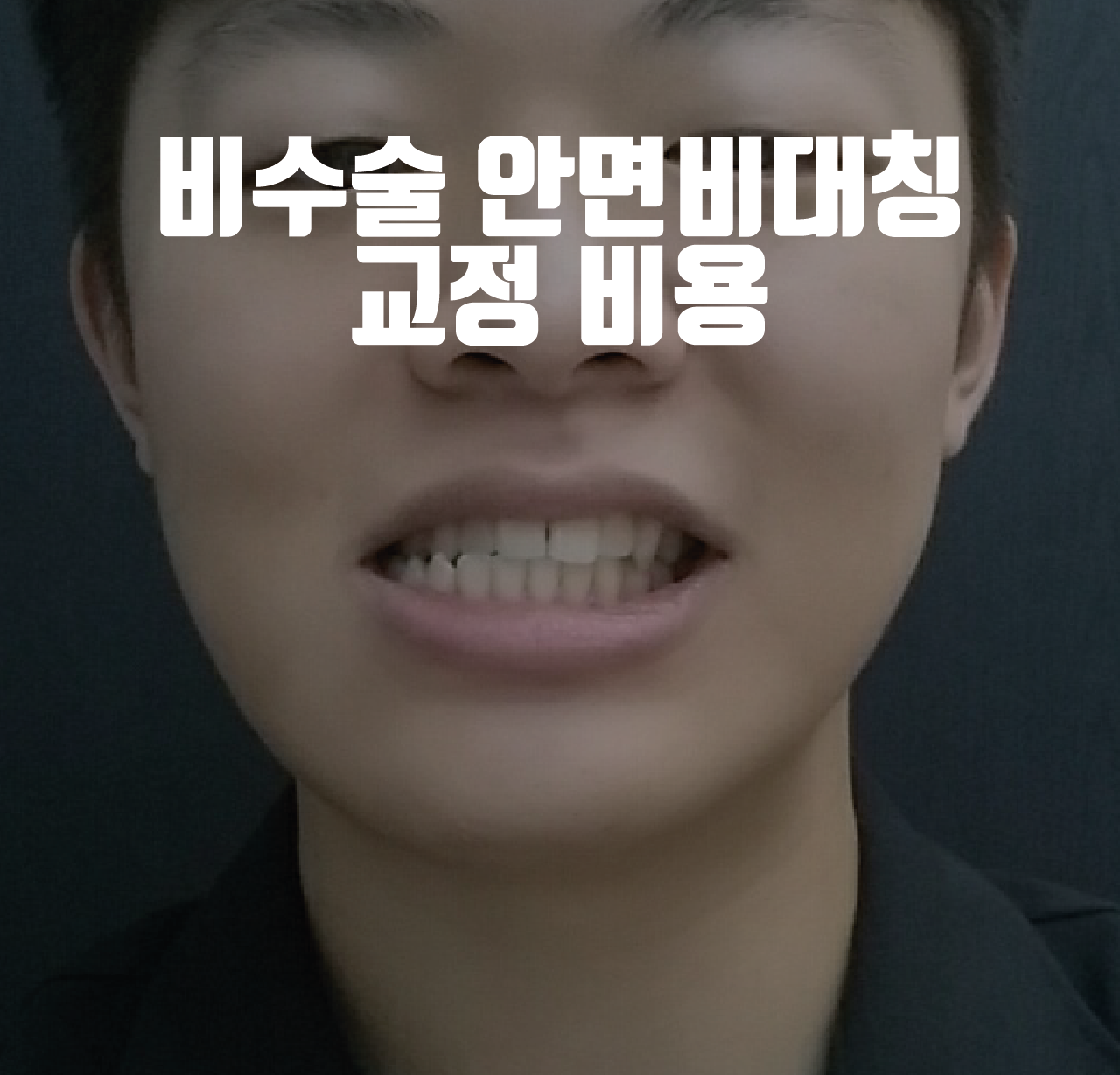 안면비대칭-교정-비용