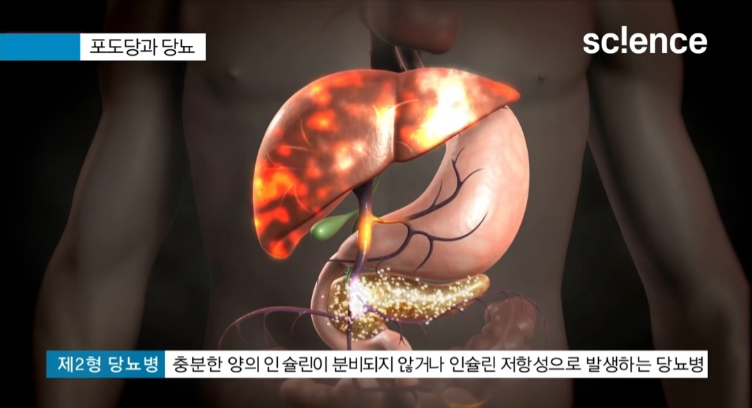 당뇨병 초기증상