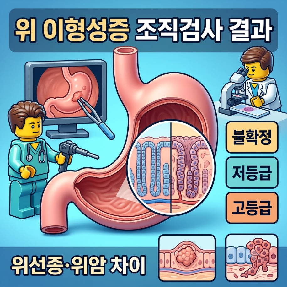 위 이형성증 조직검사 결과와 불확정&middot;저등급&middot;고등급 병리 범주, 위선종과 위암 차이를 설명하는 인포그래픽