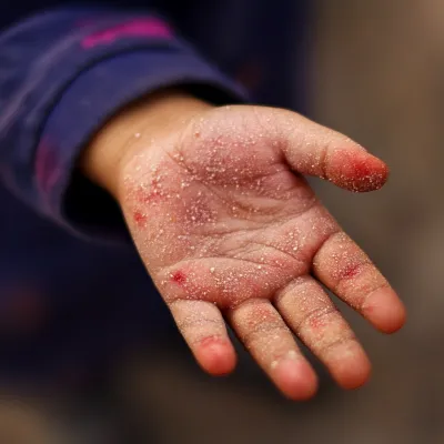 아기 수족구 증상 초기에 잡는 방법 7단계_5