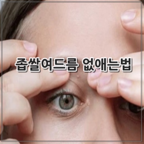 좁쌀여드름 없애는법