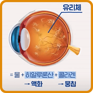눈 검은것이떠다니는것