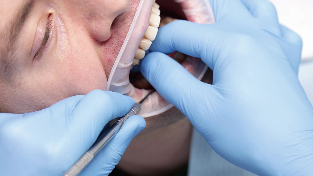 어금니 임플란트 가격