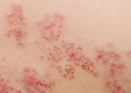 대상포진 초기증상