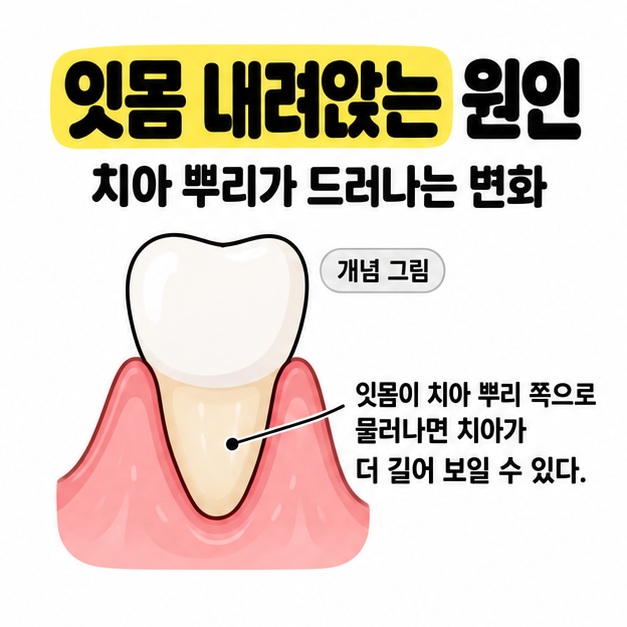 잇몸 내려앉는 원인이라는 제목 아래 잇몸이 물러나 치아 뿌리가 드러나고 치아가 길어 보이는 변화를 설명하는 개념 그림