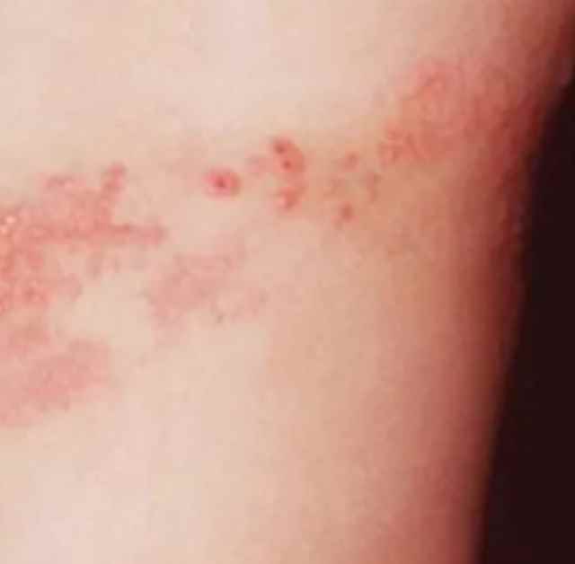 대상포진 이미지