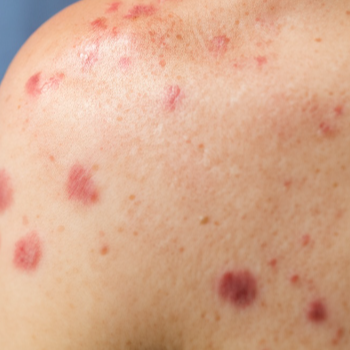 2. 수족구: 원인