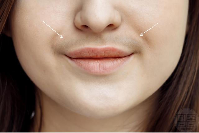 조기 폐경 전조증상 인중 수염 턱수염