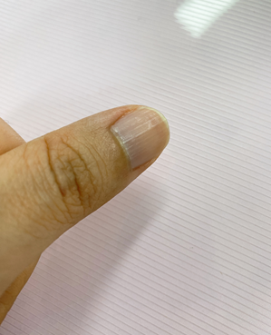 손톱 세로줄, 관리방법, 원인, 손톱 영양제 추천