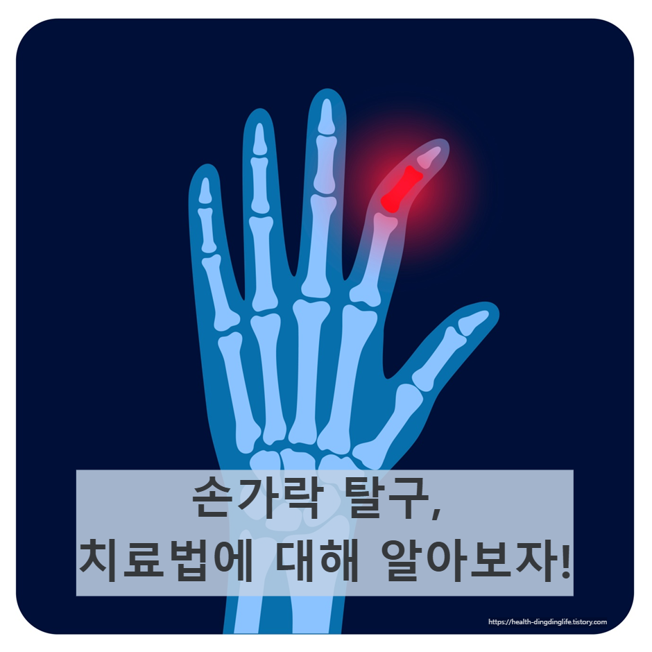 손가락 탈구 이미지 입니다.