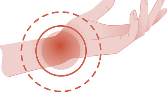 류마티스 관절염 초기증상 28
