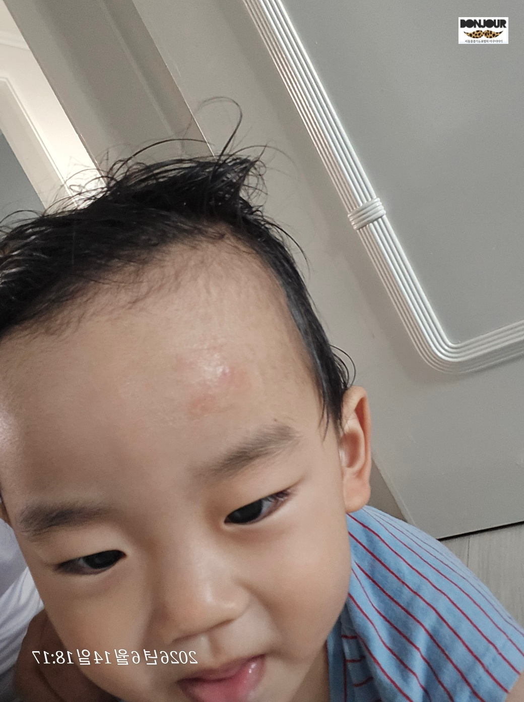 성형외과 봉합 수술 3주 후 거의 보이지 않는 아기 이마 흉터