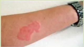 세스코 - 빈대 팔 물린 자국