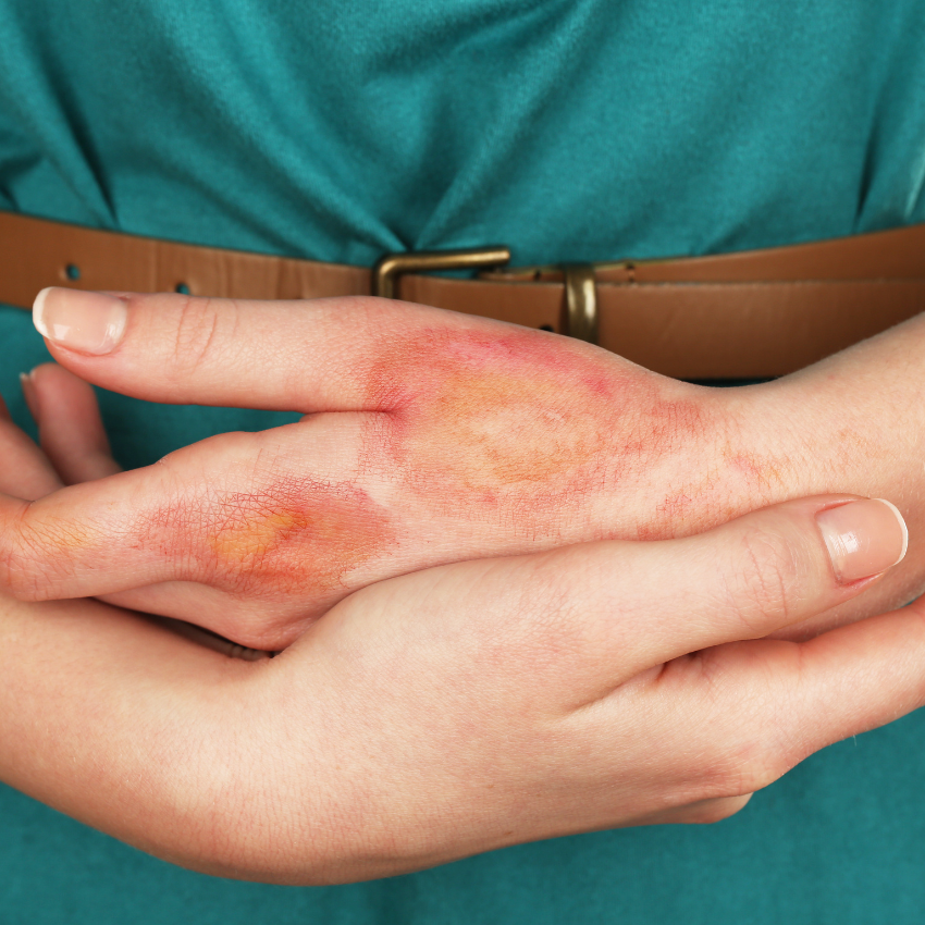 모기 퇴치 꿀팁_27