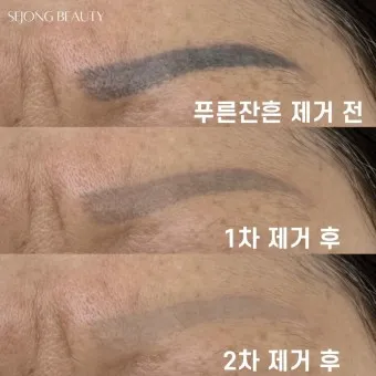 눈썹 문신 제거 방법 꿀팁_19