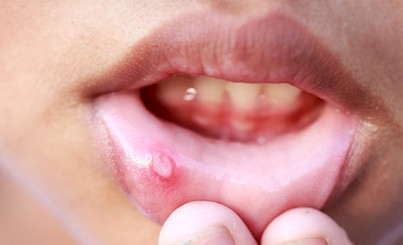 환절기 면역력 저하와 구내염, 효과적인 치료제와 관리 방법