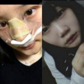 정채연 성형전 다이어트