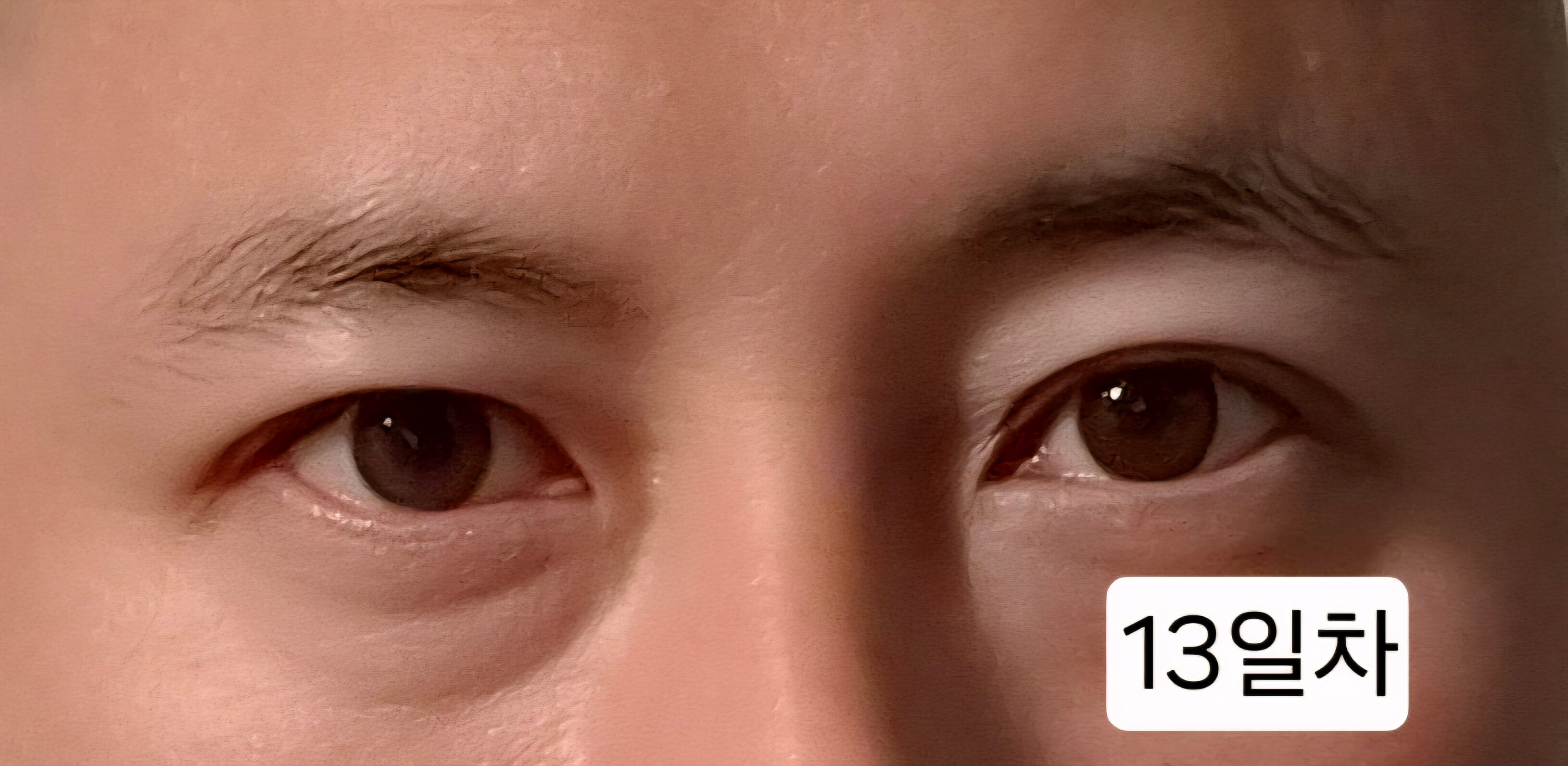 유행성각결막염 치료과정 증상 시력저하 회복과정 발병2주 3주 기록