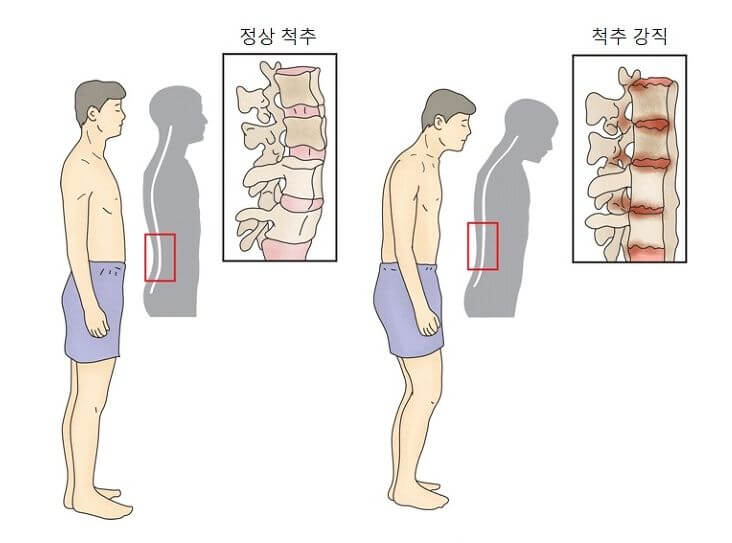 강직성척추염
