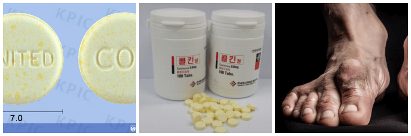 콜킨정, 통풍 발 사진