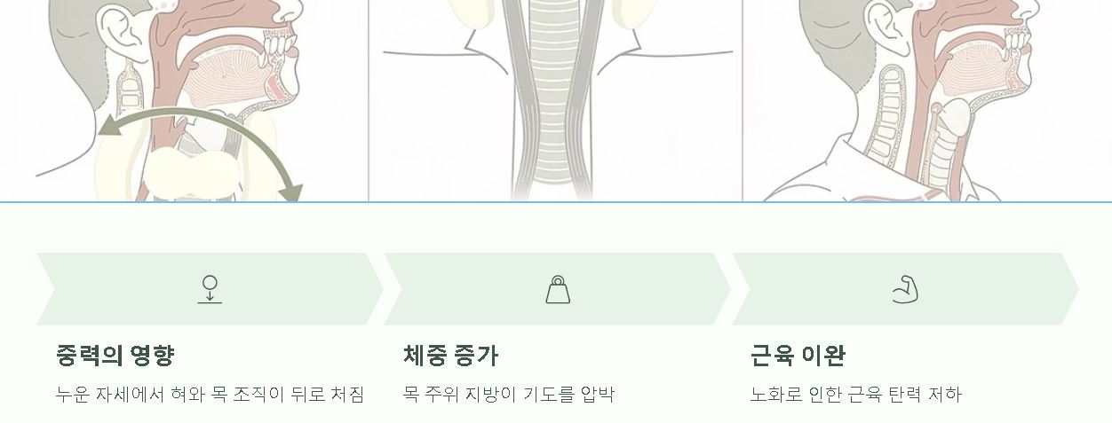 수면 무호흡증 치료