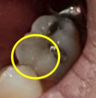 깨진 치아 레진으로 치료