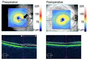 라식 라섹 차이