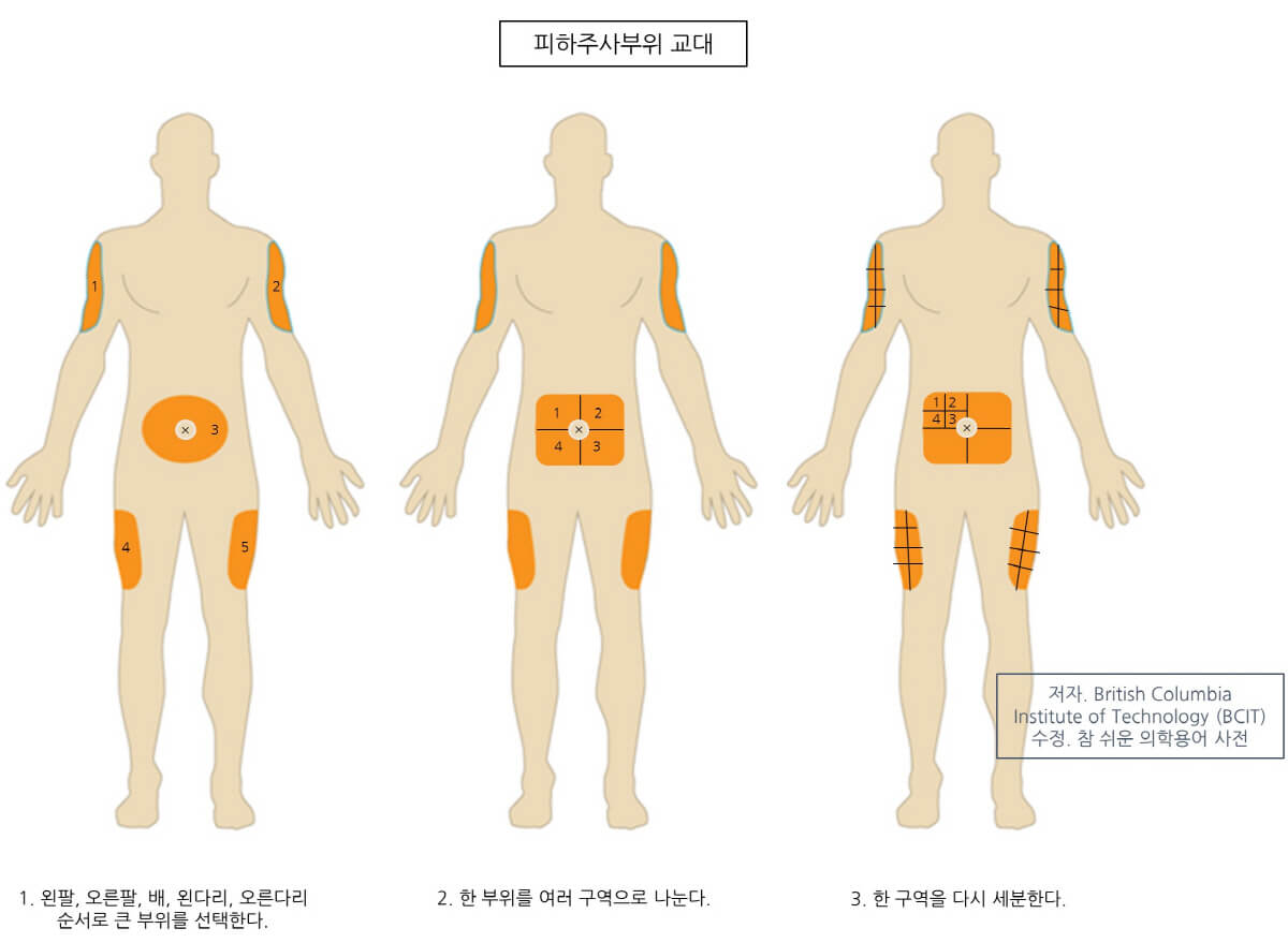 의학용어 SC, SQ injection 뜻 피하주사 부위, 피하주사 핵심술기