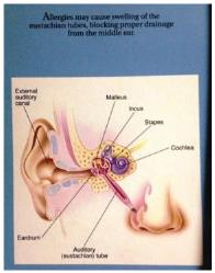 귀 이석증 이미지