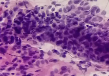 백혈구 수치가 낮은 이유 20