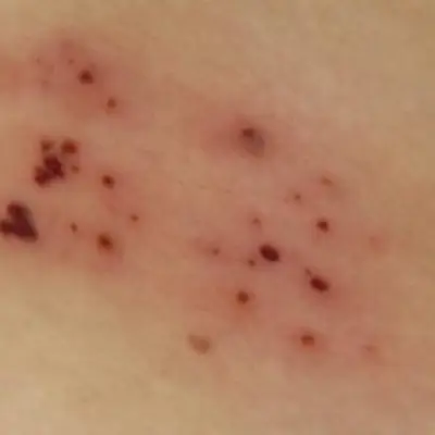 파상풍-예방접종-가격-저렴한-병원찾기-건강