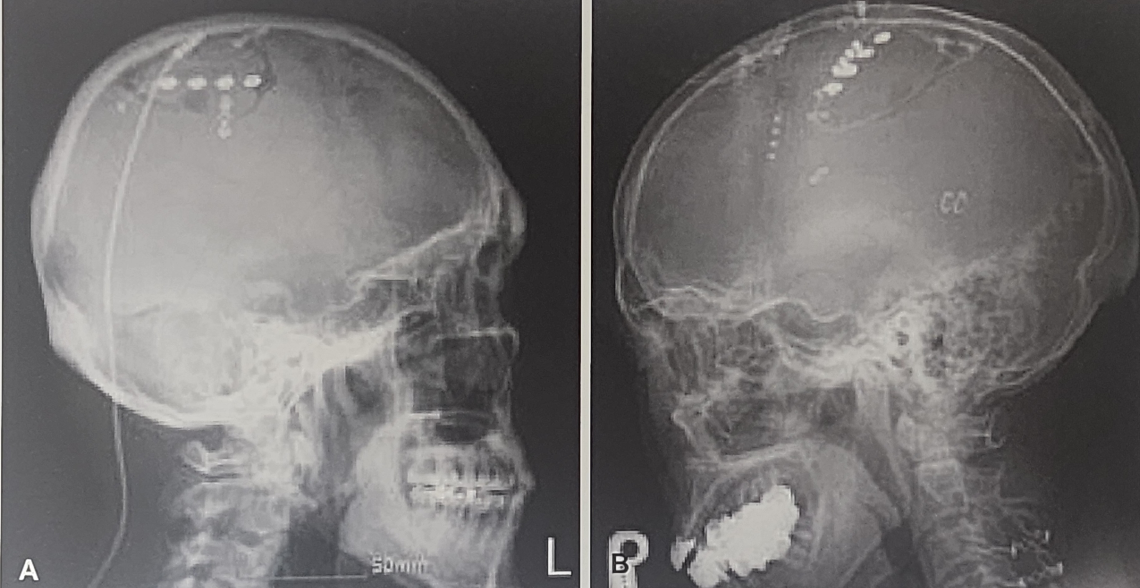 신경자극술 및 약물펌프를 이용한 약물주입치료(1)