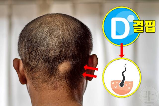비타민d 결핍 증상 비타민d권장량 탈모