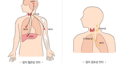 갑상선 이미지