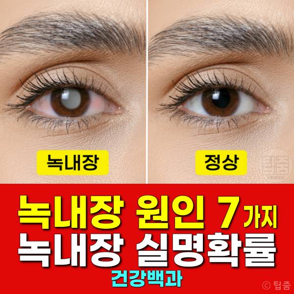 녹내장 원인 녹내장 실명확률