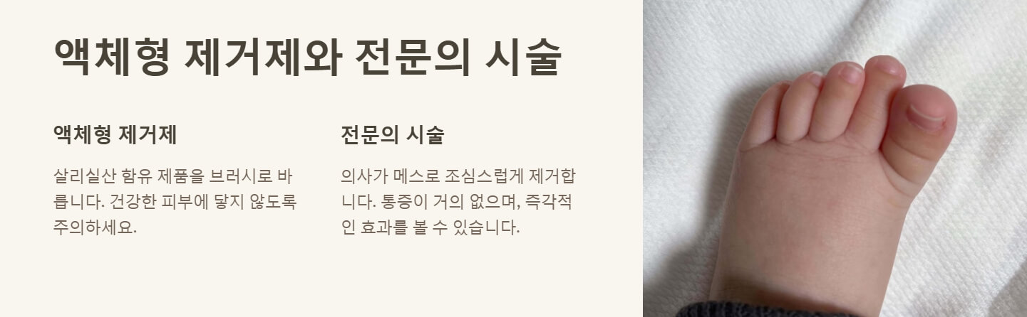 티눈 없애는 방법